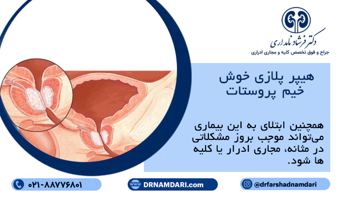 هیپر پلازی خوش خیم پروستات