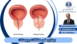 علایم پروستات ، بیماری ها و مشکلات پروستات