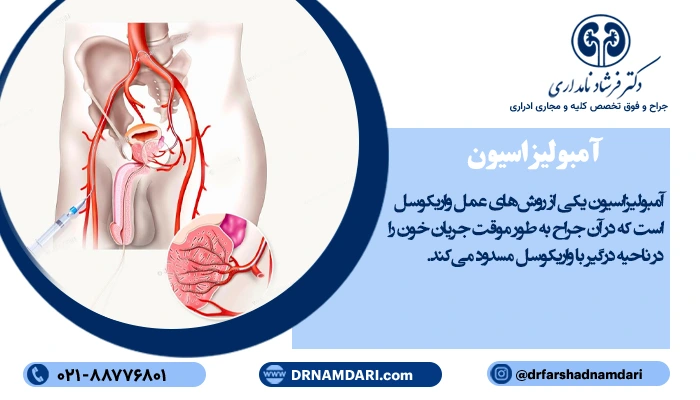 آمبولیزاسیون