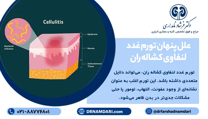 علل پنهان تورم غدد لنفاوی کشاله ران: از عفونت‌های ساده تا بیماری‌های جدی