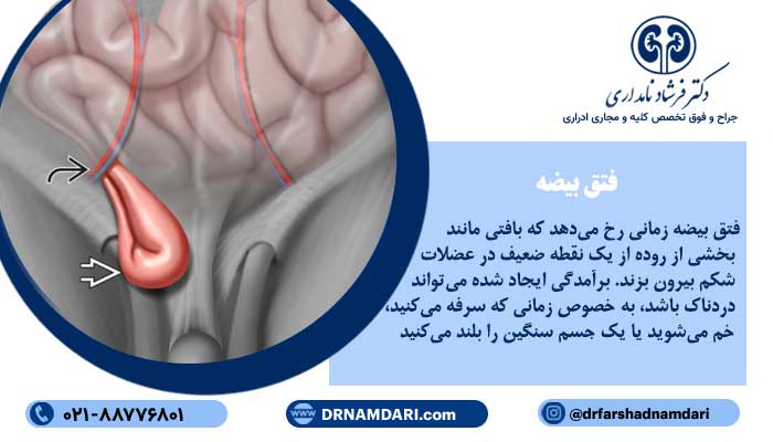 فتق بیضه