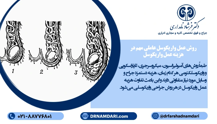 روش عمل واریکوسل عاملی مهم در هزینه عمل واریکوسل