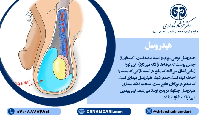 هیدروسل در معرفی بهترین جراحی هیدروسل در تهران