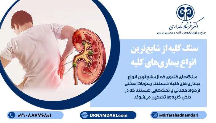 سنگ‌های کلیوی که از شایع‌ترین انواع بیماری‌های کلیه هستند