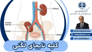 کلیه لگنی چیست؟ درمان کلیه لگنی