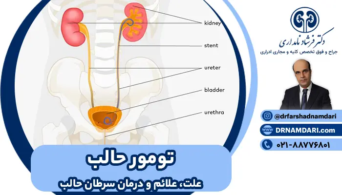 کیست حالب کلیه + آیا سرطان حالب کشنده است