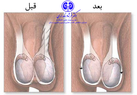 درمان پیچ خوردگی بیضه چپ یا راست