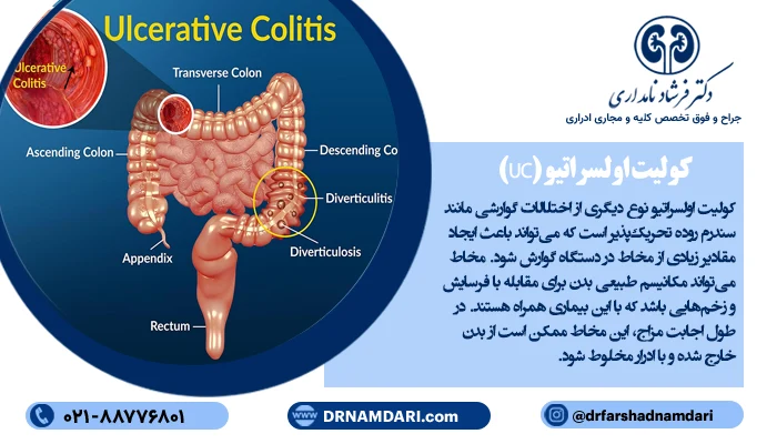 کولیت اولسراتیو نوع دیگری از اختلالات گوارشی می تواند عامل وجود موکوس در ادرار باشد