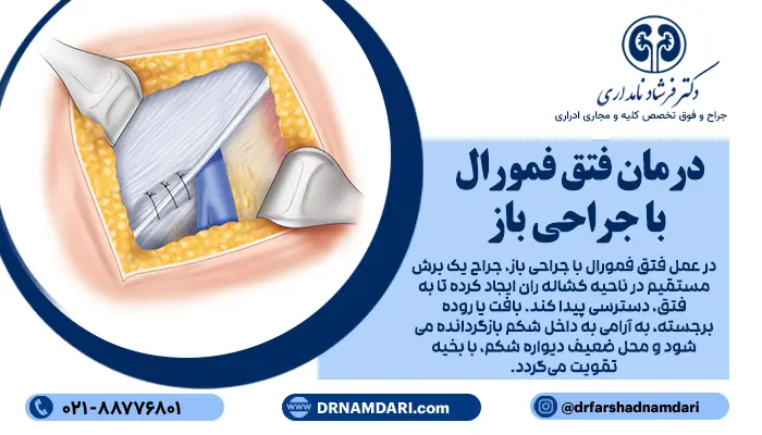 درمان فتق فمورال، به طور معمول جراحی است و بسته به شرایط بیمار و تجربه جراح، میتواند به روش باز یا لاپاراسکوپی انجام شود.