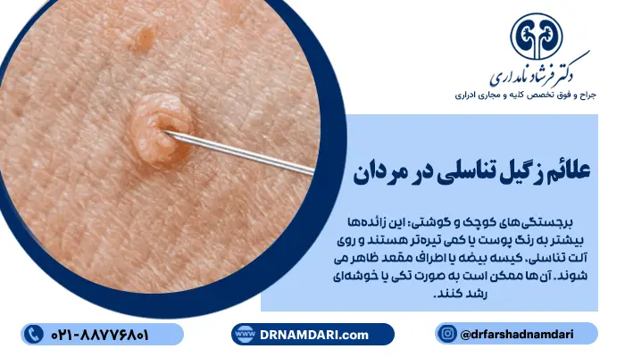 علائم زگیل تناسلی در مردان ممکن است در ابتدا خفیف و غیر قابل توجه باشند، اما با پیشرفت بیماری، این نشانهها واضحتر میشوند.