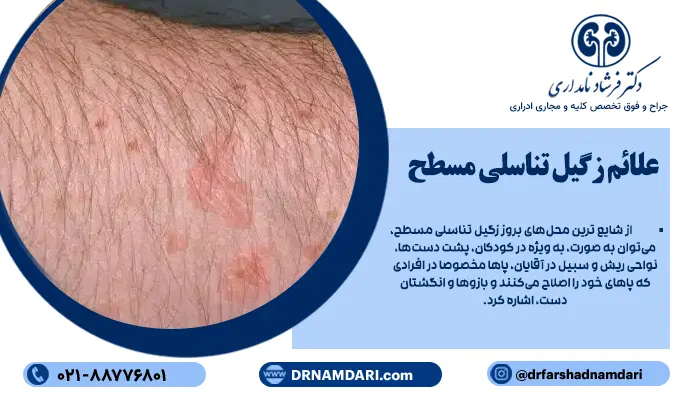 علائم زگیل تناسلی مسطح، ممکن است در ابتدا بسیار خفیف به نظر برسند. این زائدهها، اغلب در اثر تماس مستقیم پوستی یا تحریکات ناشی از اصلاح پوست، گسترش مییابند و میتوانند به شکل خوشهای در نواحی مختلف بدن ظاهر شوند.
