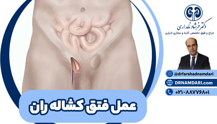 عمل فتق کشاله ران، برای ترمیم ضعف یا پارگی در دیواره شکم در ناحیه کشاله ران انجام میشود. عمل فتق مغبنی، میتواند به صورت باز یا لاپاراسکوپی انجام شود. علاوه بر ترمیم فتق یک طرفه، عمل فتق دو طرفه اینگوینال هم برای بیمارانی که هر دو سمت کشاله ران دچار فتق هستند، انجام میگیرد.