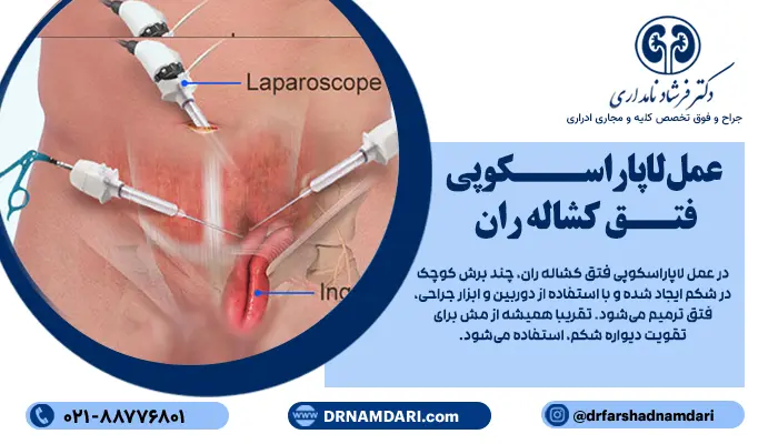 در عمل لاپاراسکوپی فتق کشاله ران، چند برش کوچک در شکم ایجاد شده و با استفاده از دوربین و ابزار جراحی، فتق ترمیم میشود. تقریبا همیشه از مش برای تقویت دیواره شکم، استفاده میشود. این روش عمل فتق، به طور معمول درد کمتر و بازگشت سریعتر، به فعالیتهای روزمره دارد.