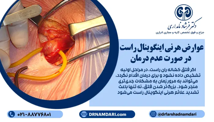 بزرگتر شدن فتق، نه تنها باعث تشدید علائم هرنی اینگوینال راست میشود؛ بلکه خطر عوارضی مانند حبس شدن یا مختنق شدن روده را نیز، افزایش میدهد.