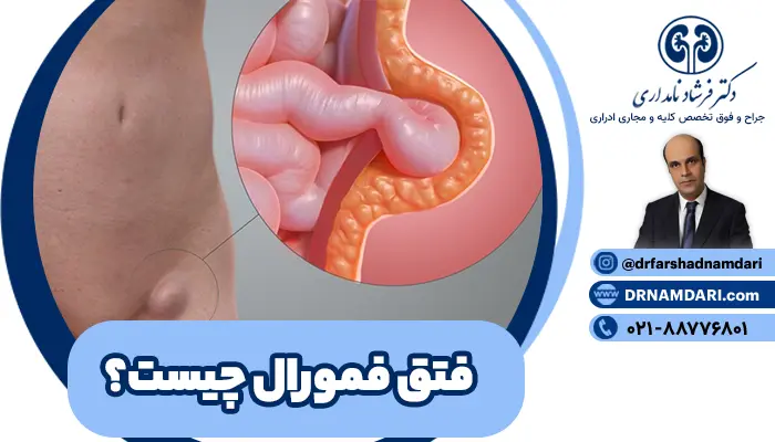 فتق فمورال یا همان فتق رانی، یکی از انواع کمتر شایع فتقها بوده و زمانی رخ میدهد که بخشی از روده یا بافتهای شکمی، از یک نقطه ضعیف در دیواره شکم عبور کرده و وارد کانال فمورال، در ناحیه کشاله ران و بالای ران شوند.