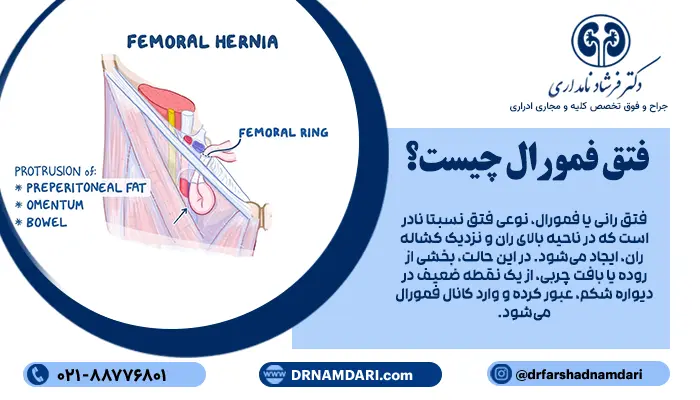 فتق رانی یا فمورال، نوعی فتق نسبتا نادر است که در ناحیه بالای ران و نزدیک کشاله ران، ایجاد میشود.