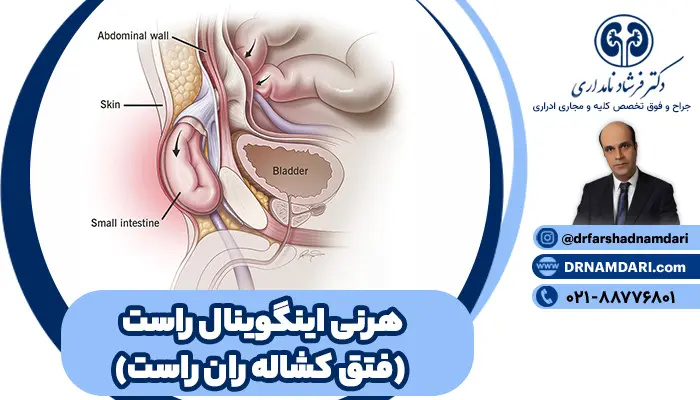 هرنی اینگوینال راست یا فتق کشاله ران راست، یکی از شایعترین مشکلات جراحی ناحیه شکم و کشاله ران است که در هر سنی، میتواند بروز کند.