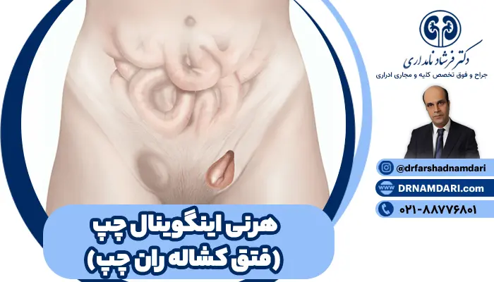 هرنی اینگوینال چپ یا همان فتق کشاله ران چپ، یکی از شایعترین مشکلات جراحی است که در اثر بیرونزدگی بخشی از روده یا بافت شکمی از میان دیواره ضعیف عضلات ناحیه کشاله ران، ایجاد میشود